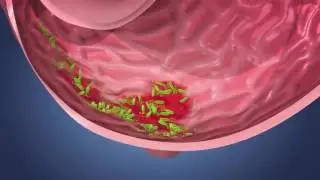 Хронический гастрит, язвенная б нь желудка и 12 типерстной кишки  Helicobacter pylori