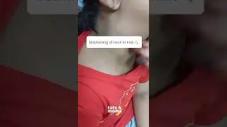 Blackish Skin around Kids Neck | Insulin Resistance