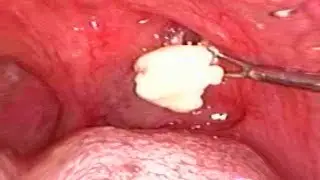 Compilation of My Extreme Tonsil Stones!