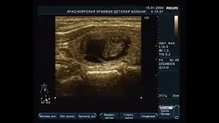 Видеозапись УЗИ - Смешанный солидно-кистозный узел - TIRADS 2