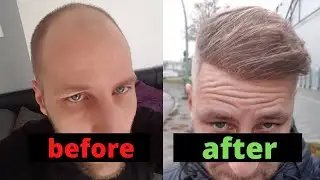 From Day 0 to Month 12 - Hair Transplant Turkey Comparison