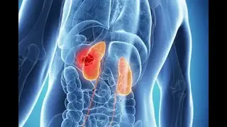 Лапароскопическая внебрюшинная резекция правой почки. RENAL 5.