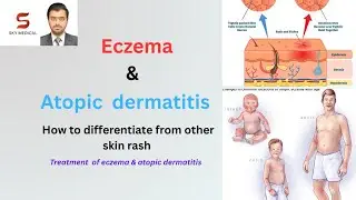 Eczema(atopic dermatitis) causes , factors & TREATMENT