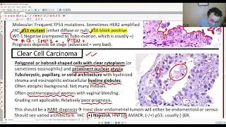 GYN PATHOLOGY: ENDOMETRIAL TUMORS 2
