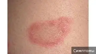 Лишай  Как лечить лишай