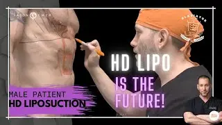 Male Gladiator 360 HD Lipo & Tummy Tuck: The FUTURE Is With HD Liposculpture | Dr. Jason Emer
