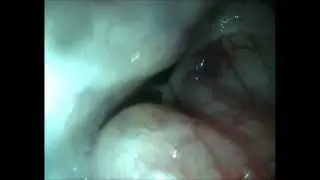 posterior rhinoscopy