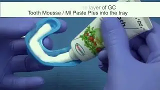 Cómo aplicar MI Tooth Mousse/MI Paste Plus? - Remineralizantes y desensibilizantes