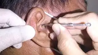 Removing Man's Massive Earwax
