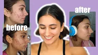 how i cured my acne | day & night skincare routine