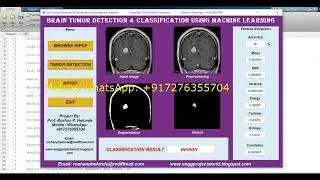 Detection Of Brain Tumor Using Machine Learning Matlab Project With Source Code Brain Tumor Detect
