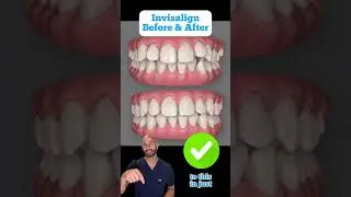 Invisalign Fort Lauderdale Orthodontist