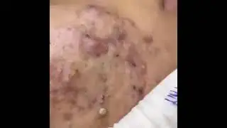 чистить лицо от прыщей 