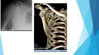 Orthopedic Trauma: Upper extremity (1)