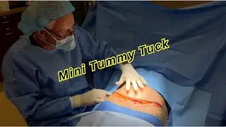 Mini Tummy Tuck | Orange County Plastic Surgery