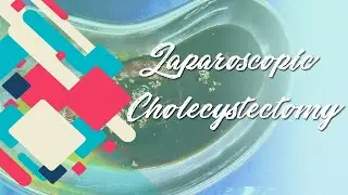 Laparoscopic Cholecystectomy