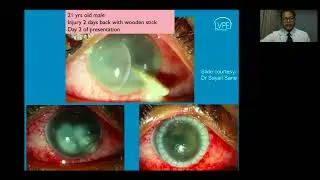 Managing Anterior Segment Trauma