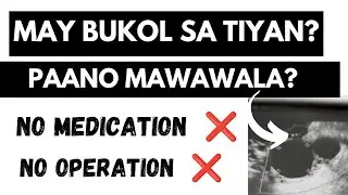 MAY BUKOL SA TIYAN WALANG OPERASYON