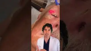 This Treatment Erases Wrinkles! 😍 (Erbium Laser / CO2 Laser Combination Treatment)