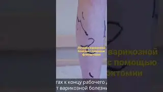 Операция при варикозе: как работает сосудистый хирург