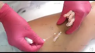 Подтяжка коленей нитями PDO