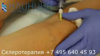 Склеротерапия FoamForm