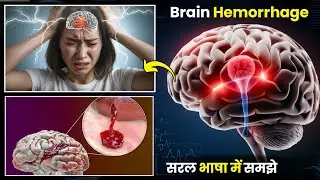 Brain Hemorrhage क्या होता है? Symptoms, Treatment, Recovery Time in Hindi