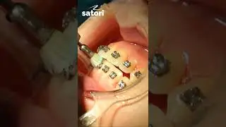 Профессиональная чистка зубов с брекетами 