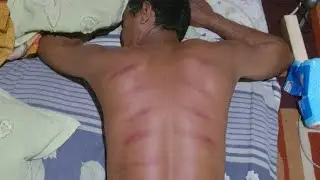 Kerokan masuk angin||kerokan kehujanan||kerokan Mbah Maryono