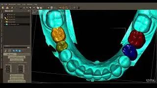 QuickVision 3D Tutorials - Waxup