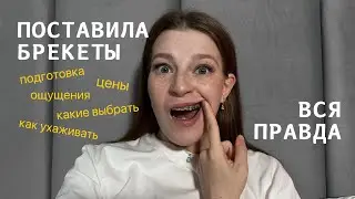 Брекеты установка дешево | моя история | влог | цена | что есть |гигиена | посмотри, перед лечением