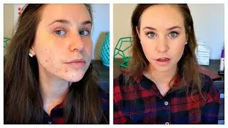 How To Cover Acne Scars With Makeup: Acne Coverage Foundation Routine