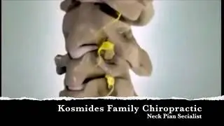 Cervical Radiculopathy Kosmides Family Chiropractic