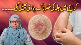 Hot weather causing skin ailments | Fungal Infection | کراچی میں جلدی بیماریاں پھیل گئیں