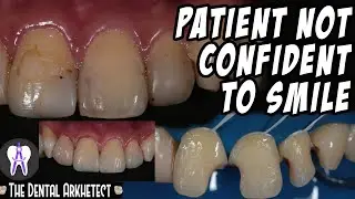Bringing Back His Confidence. Tooth Filling Replaced! Middle Part is the Best  4K 