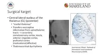 Abdul-Kareem Ahmed: Bilateral MR-Guided FUS for Refractory Trigeminal Neuralgia