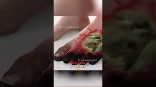 Gangrene (3D Animation)