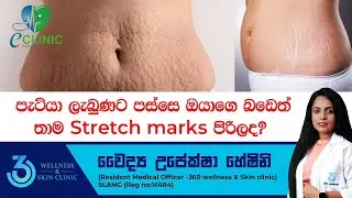පැටියා ලැබුණට පස්සෙ ඔයාගෙ බඩෙත් තාම Stretch marks පිරිලද ? | 360 wellness & Skin Clinic