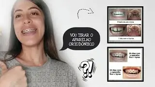 COMO ESTA MEU TRATAMENTO ORTODÔNTICO?? DEPOIS DE 2 ANOS (APARELHO FIXO ) #diariodoaparelho