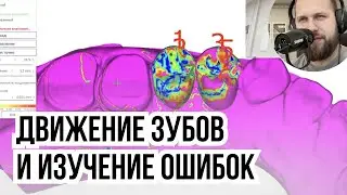 Движение зубов и изучение ошибок. Кто виноват?