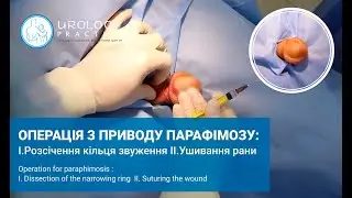 ПАРАФІМОЗ: операція з приводу парафімозу, лікування парафімозу / Operation for paraphimosis