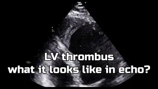 Apical thrombus (Left ventricle)