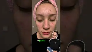 ПОДРОСТКОВОЕ АКНЕ. КОГДА ТЕРАПИЯ НАЧАТА ВО ВРЕМЯ 🤍♥️🤍