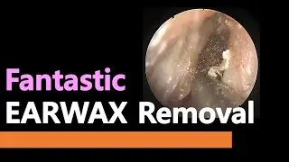 Fantastic huge EARWAX removal