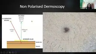 Dermoscopy An Overview | #eastwestpharma