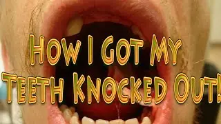 HOW I GOT MY TEETH KNOCKED OUT!