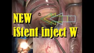 How to iStent: NEW iStent Inject W or Wide (MIGS)