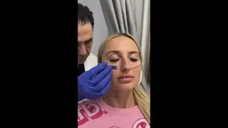 Non-surgical Cheek Lift