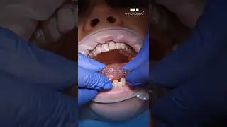Установка элайнеров EUROKAPPA🦷 