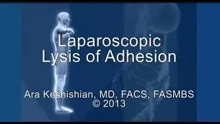 Laparoscopic Lysis of Adhesion